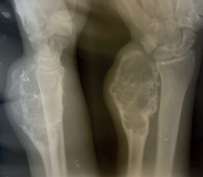 Figure 2 The X-ray of the right wrist