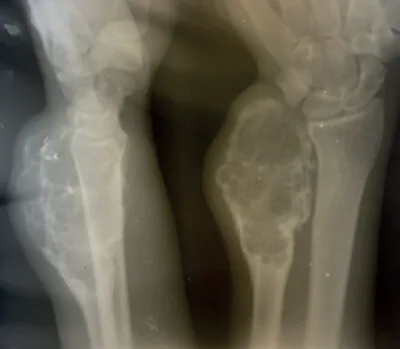 Figure 2 The X-ray of the right wrist