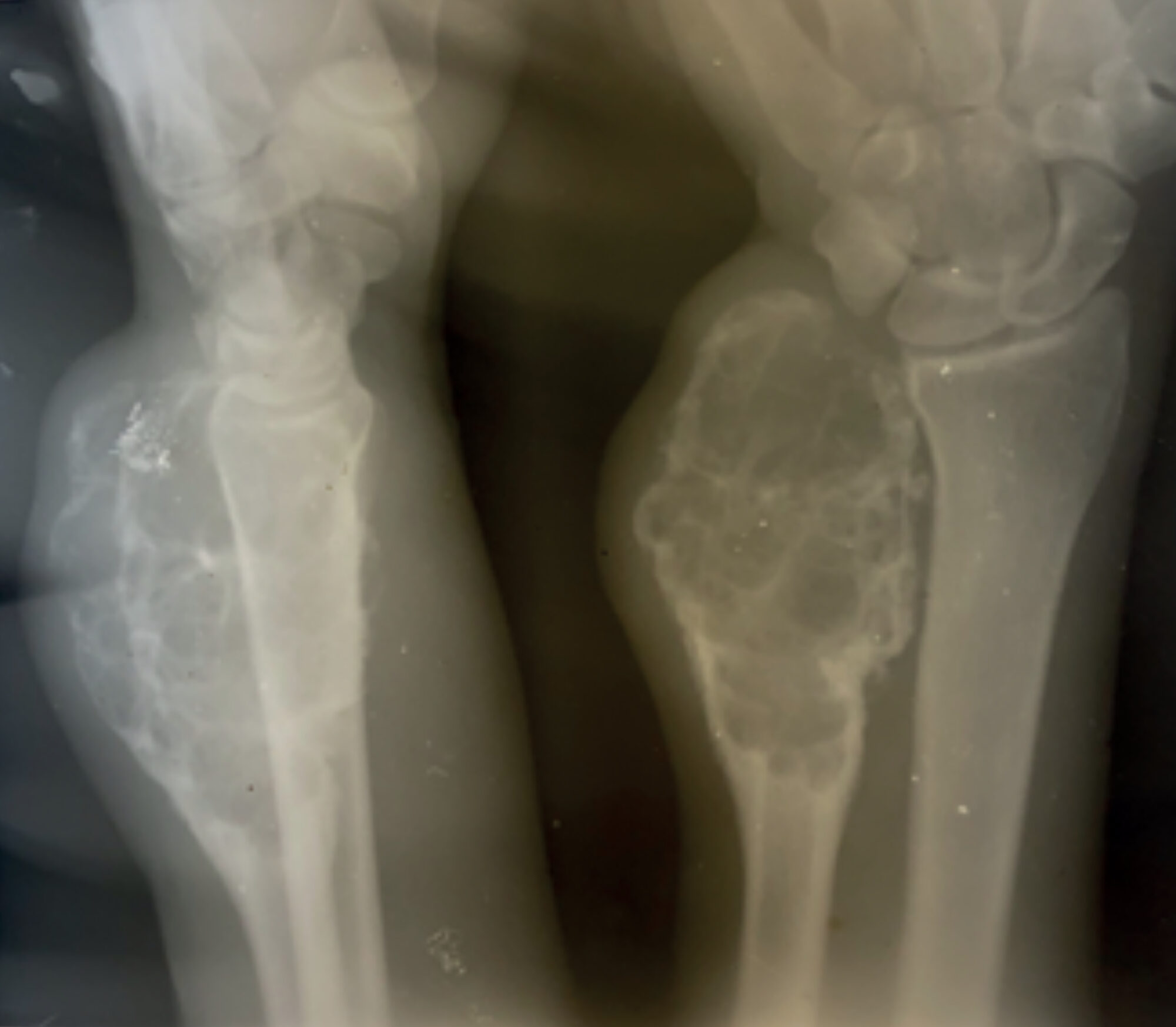 Figure 2 The X-ray of the right wrist