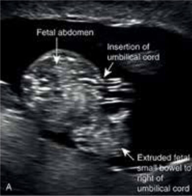 Figure 1A. An illustration of gastroschisis. A sonogram showing the defect in a sixteen-week foetus.