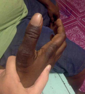 Leathery, thickened skin of the thumb below the nail with dark discoloration