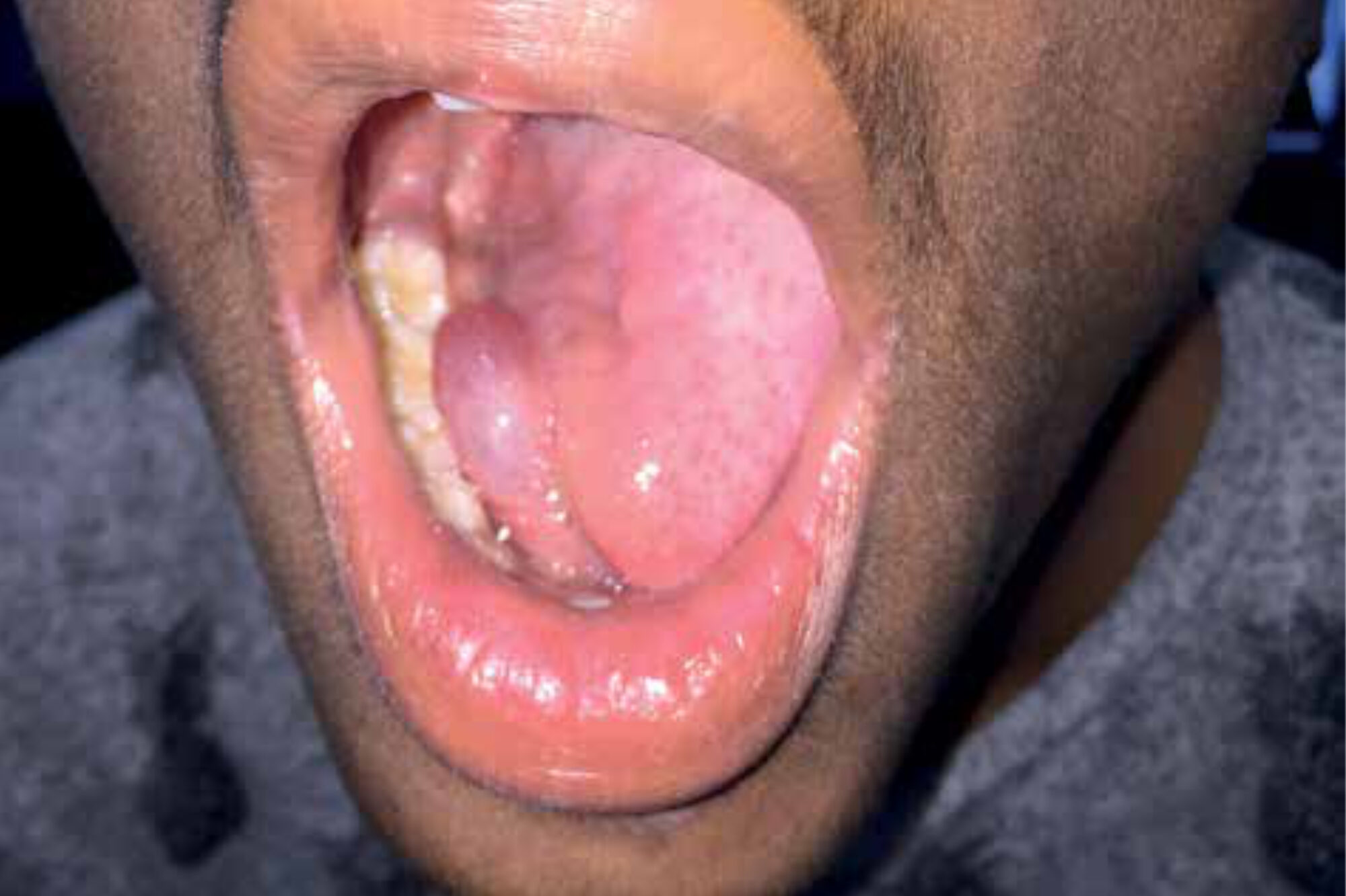 Figure 2. Characteristic sublingual ranula; note bluish appearance.