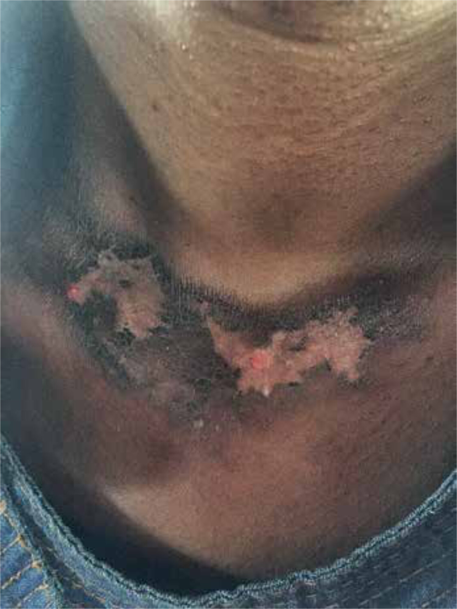 Photo 2. Secondary bacterial infection of the wounds on both feet.