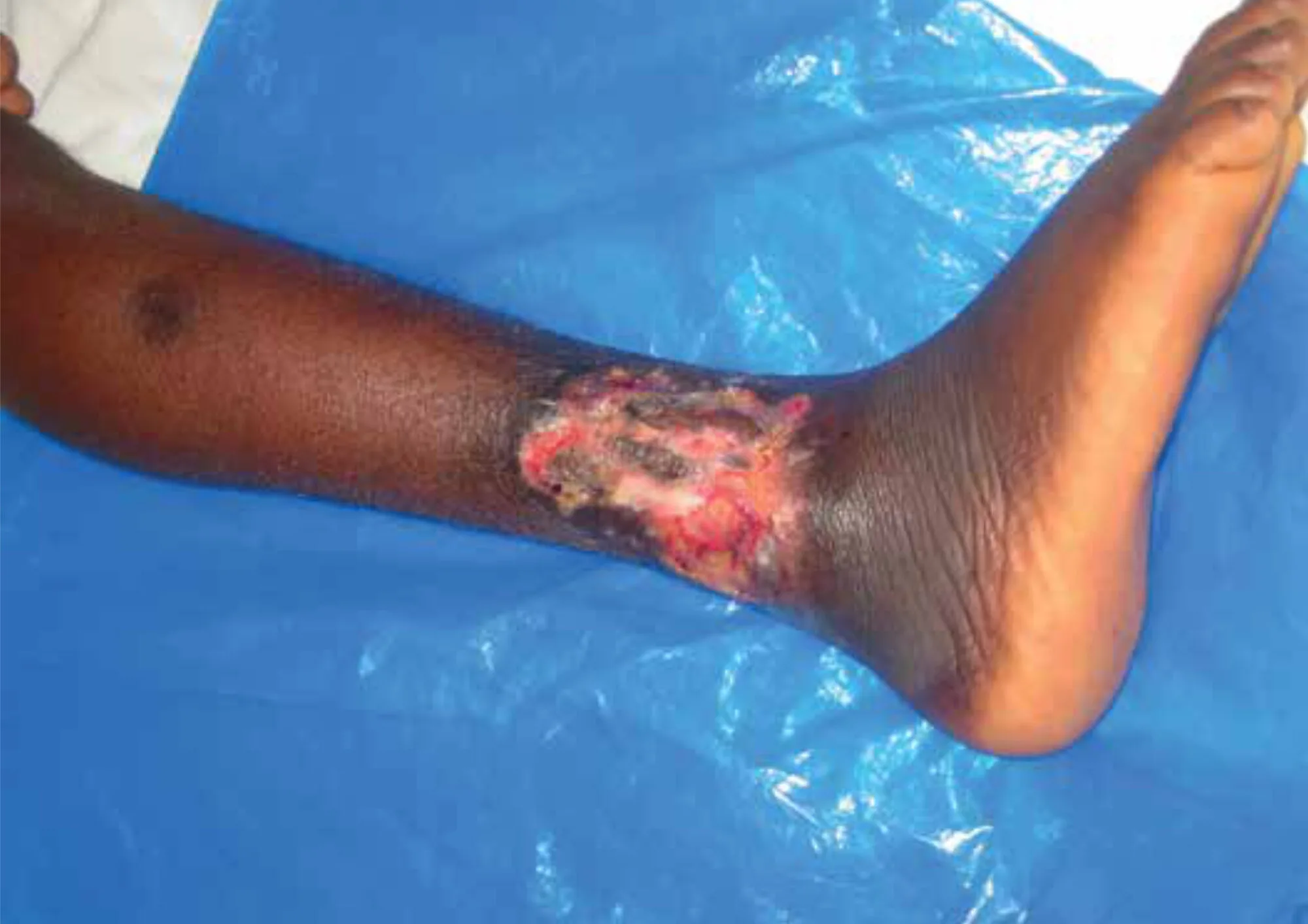 Figure 1: A typical example of Buruli ulcer.