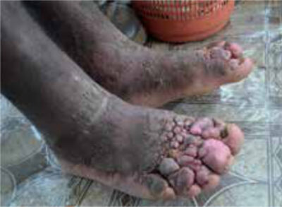 Figure2. Bilateral swelling of the legs and multiple firm nodules of different sizes mainly on
the toes.