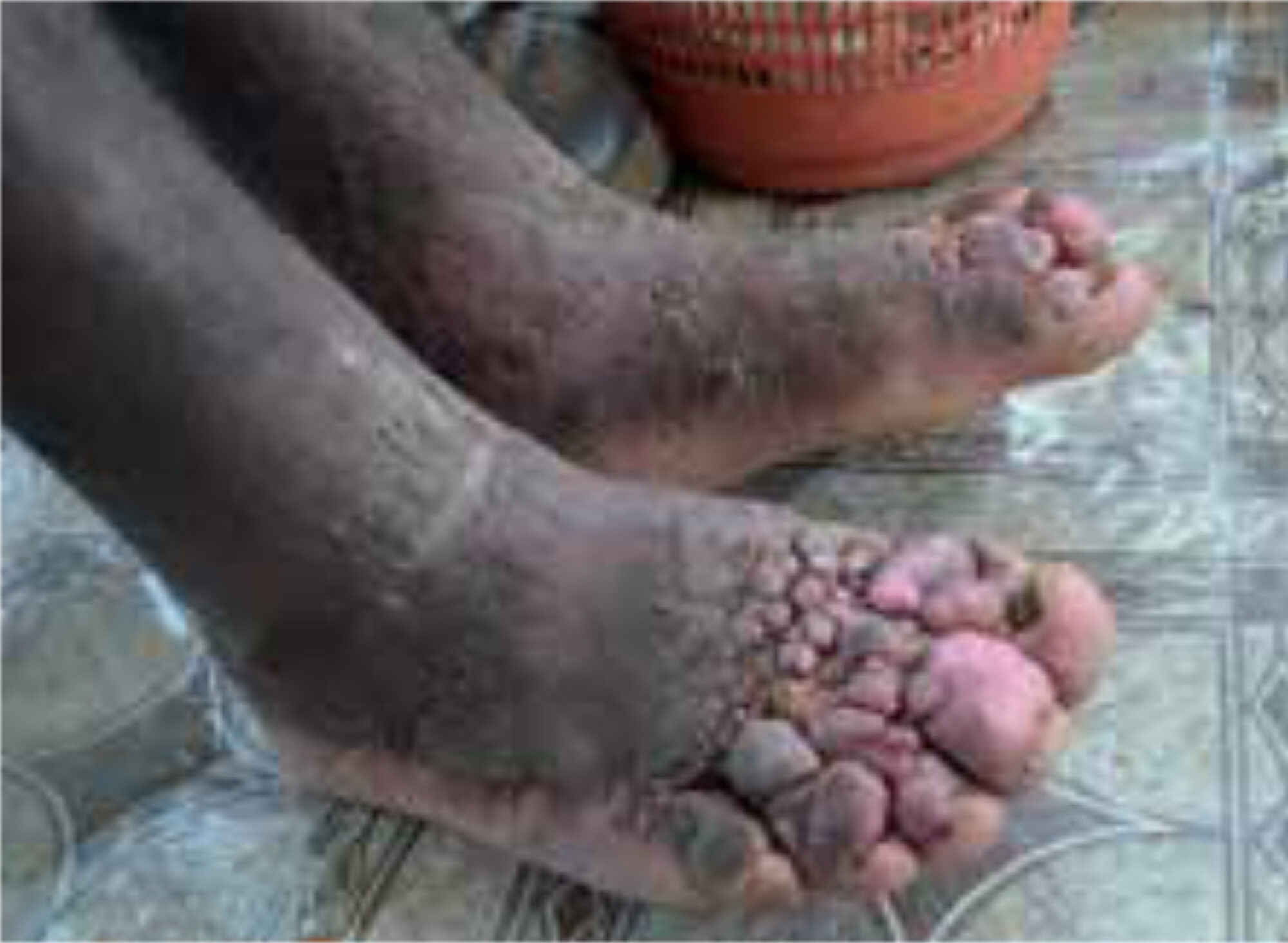 Figure2. Bilateral swelling of the legs and multiple firm nodules of different sizes mainly on the toes.