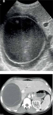 Figure 4: Ultrasound and CT-scan in a patient with type 2 Gharbi cyst.