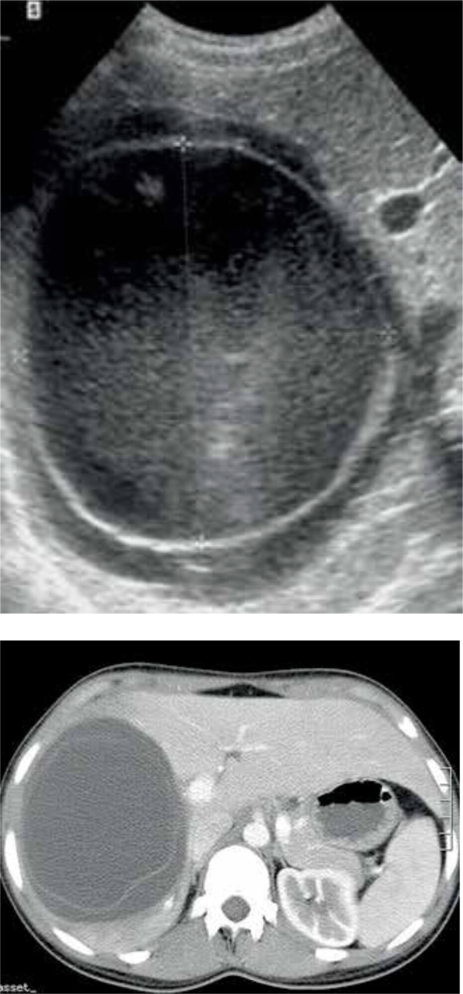 Figure 4: Ultrasound and CT-scan in a patient with type 2 Gharbi cyst.
