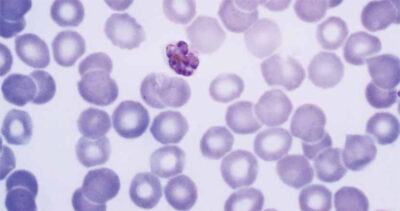 Photo: Dr. Mae Melvin, The Centers for Disease Control and Prevention Plasmodium malariae