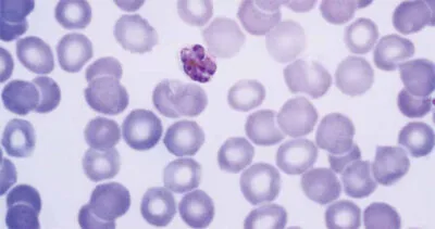 Photo: Dr. Mae Melvin, The Centers for Disease Control and Prevention Plasmodium malariae