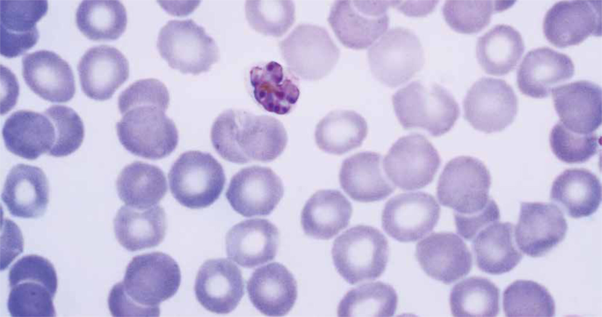 Photo: Dr. Mae Melvin, The Centers for Disease Control and Prevention Plasmodium malariae