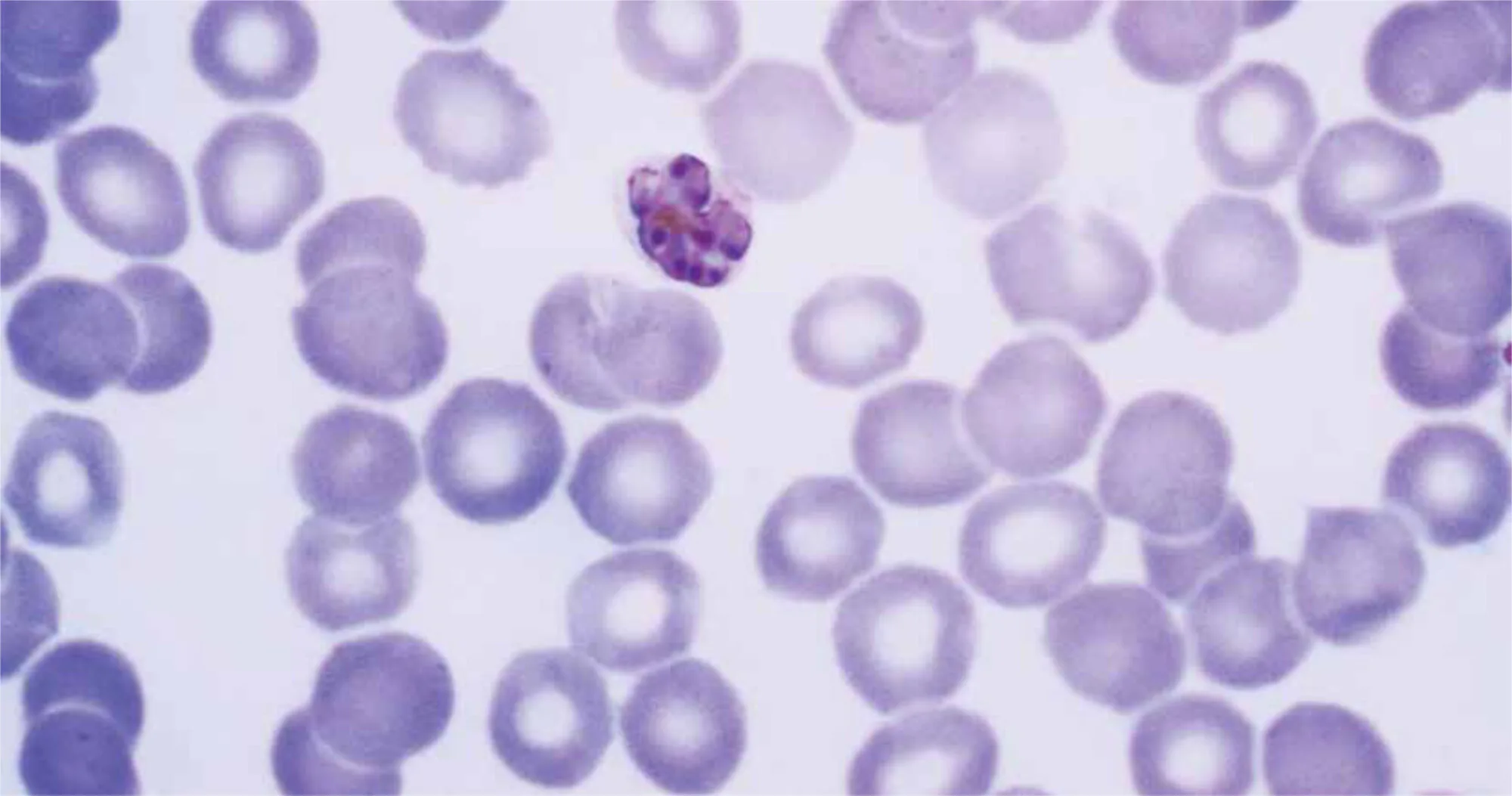 Photo: Dr. Mae Melvin, The Centers for Disease Control and Prevention Plasmodium malariae