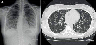 Figure 2. Extensive bilateral nodular lesions in the lungs caused by histoplasmosis on a chest X-ray (A) and a CT scan (B).