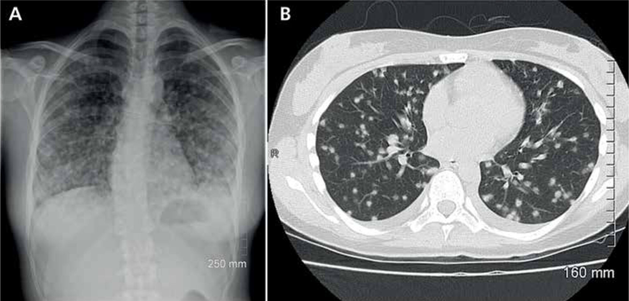 Figure 2. Extensive bilateral nodular lesions in the lungs caused by histoplasmosis on a chest X-ray (A) and a CT scan (B).