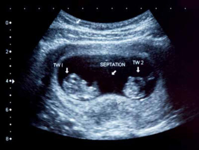 Ultrasound scan of twin boys