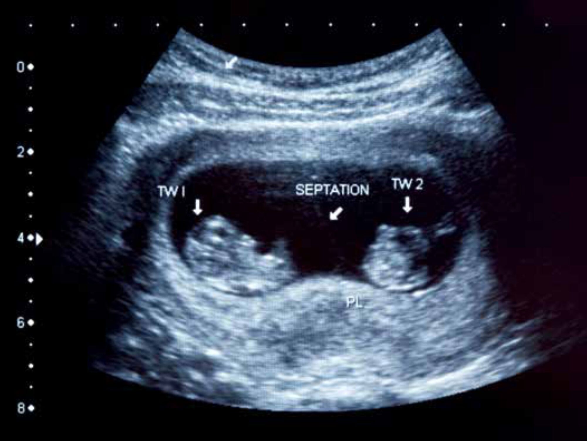 Ultrasound scan of twin boys