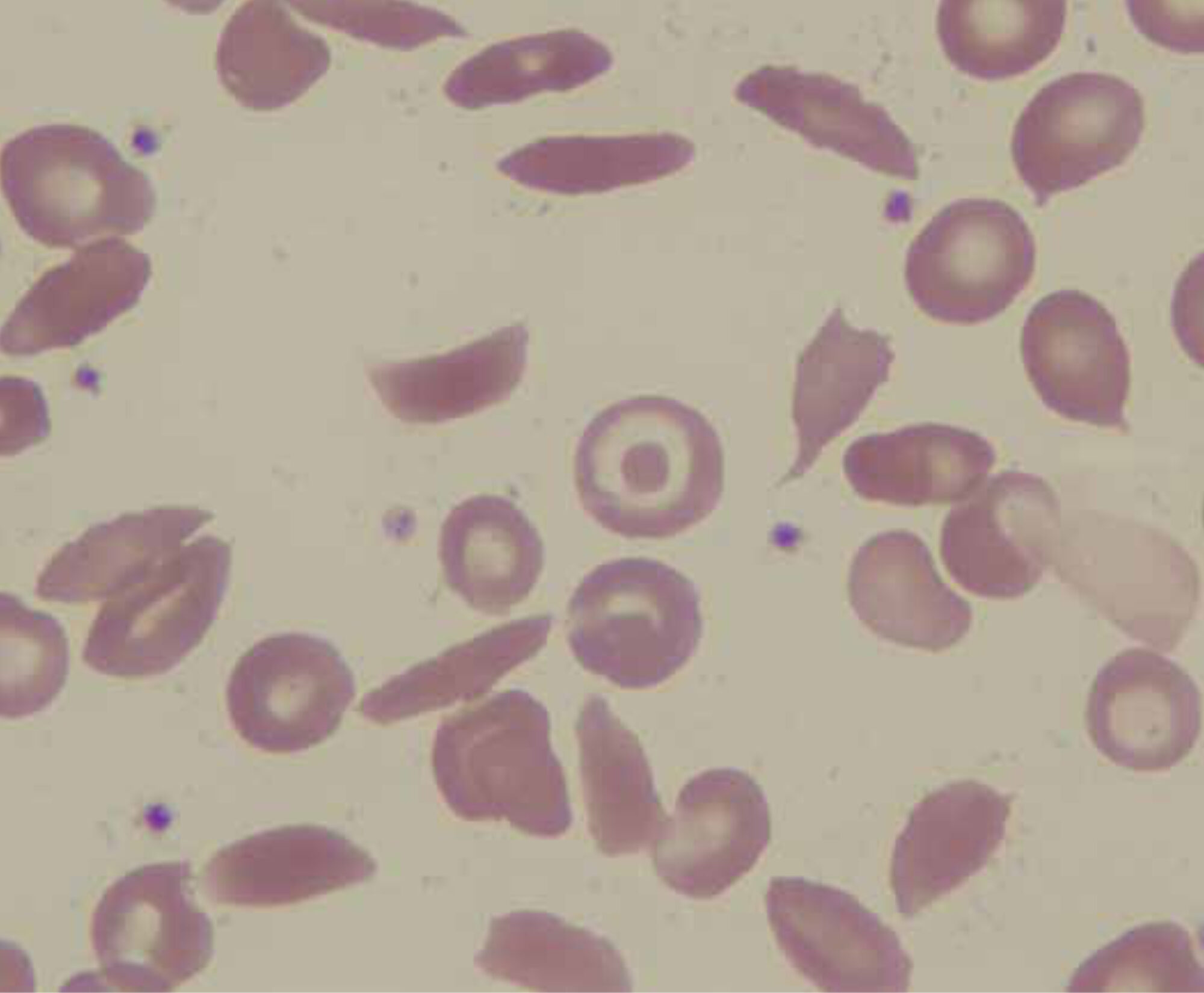 Multiple sickle cells in a blood smear