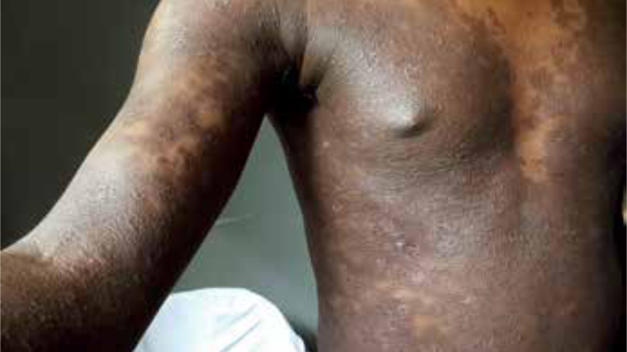 Annular lesions with an edge consisting of papules strung together.