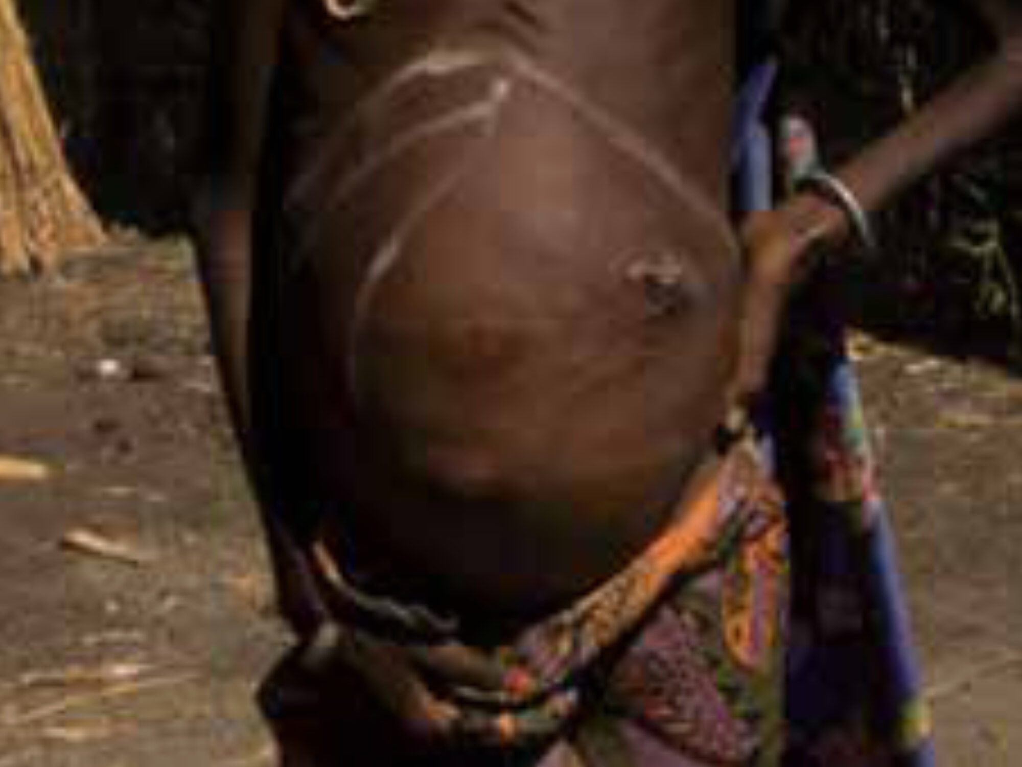 Figure 1: Typical VL patient presenting with weight loss, hepatomegaly and a huge spleen. Cautery marks are seen in the skin overlying the spleen as the result of traditional medicine.